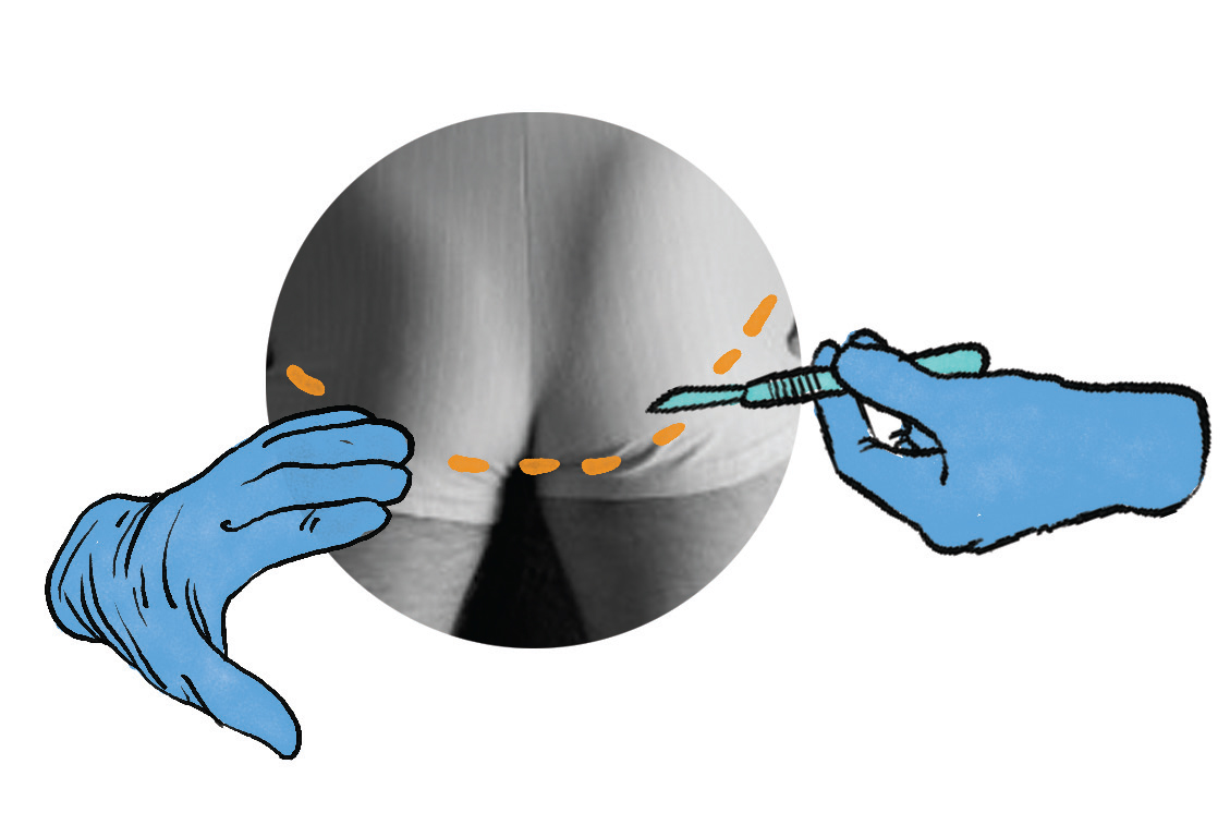 phẫu thuật thẩm mỹ nâng mông