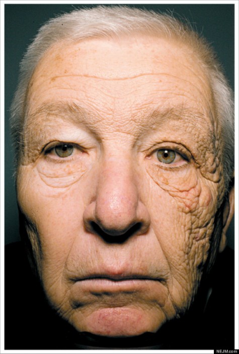 Gương mặt gây sốc của Bill McElligott dưới tác động của tia UVA