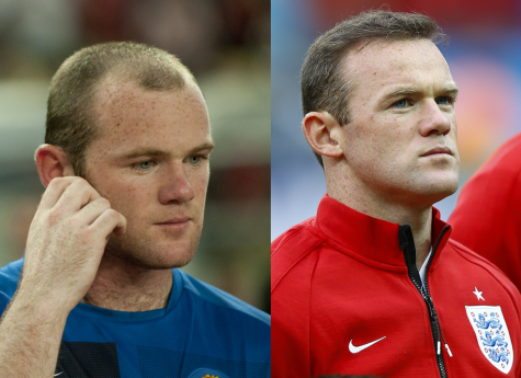 Ngoài Rooney, nhiều diễn viên nổi tiếng khác trong đó có James Nesbitt cũng thay đổi nhờ cấy tóc. 