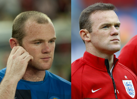 Bên cạnh Rooney, rất nhiều diễn viên tên tuổi khác bao gồm James Nesbitt cũng thay đổi nhờ hair transplant. 