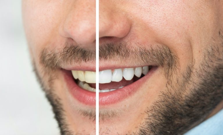 Răng trở nên trắng vì nhiều lý do.