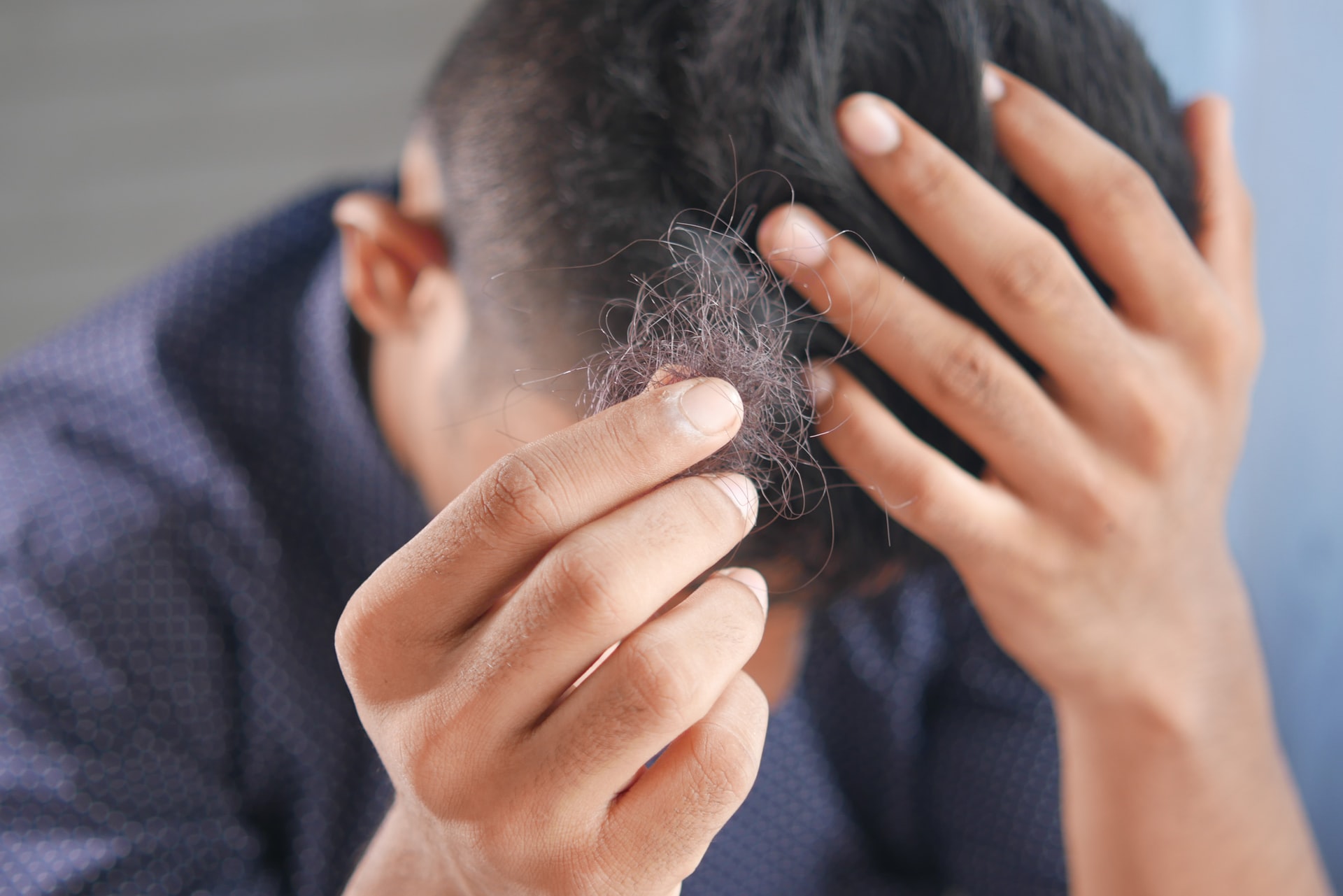 Hói đầu ở đàn ông có thể điều trị không  Vinmec