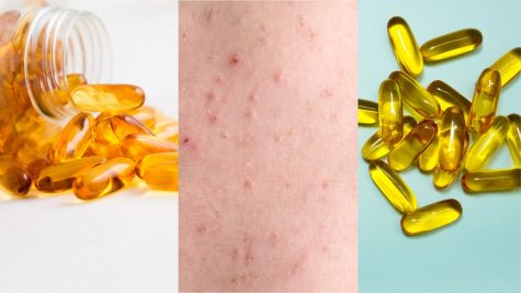 Vì sao bạn nên tìm hiểu về Omega-3 để trị mụn hiệu quả?