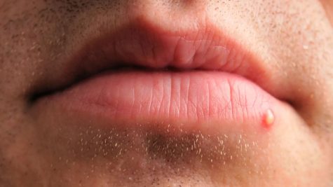 Làm sao thoát khỏi sự khó chịu khi bị mụn ở môi?