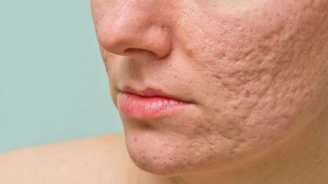 Sẹo mụn và điều bạn cần biết để lấy lại làn da khỏe mạnh